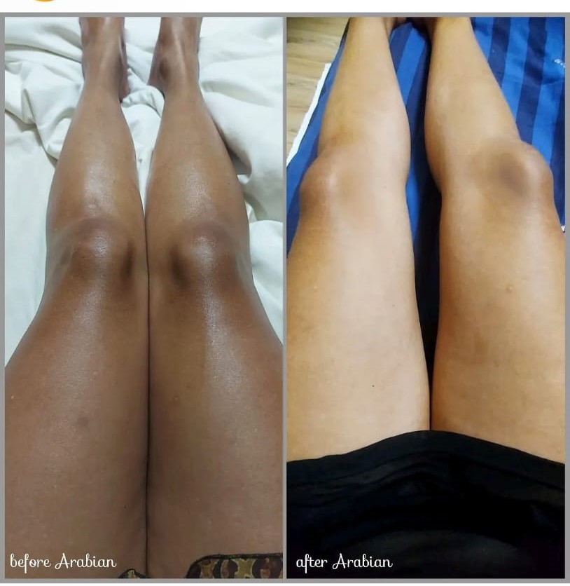 Real Glow Envy client before and after — face hyperpigmentation cleared naturally