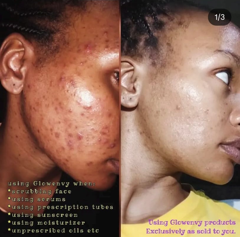 Glow Envy Before In Progress After — sunburn and hyperpigmentation cleared