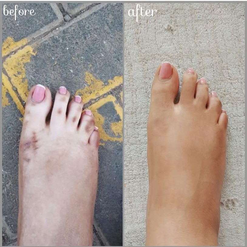 Glow Envy Before In Progress After — sunburn and hyperpigmentation cleared
